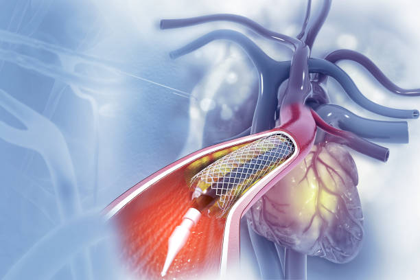 Angioplasty Cost in Amritsar: Stent Types, Package Prices & EMI Options